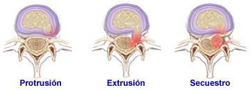 Etapas de la Hernia de Disco